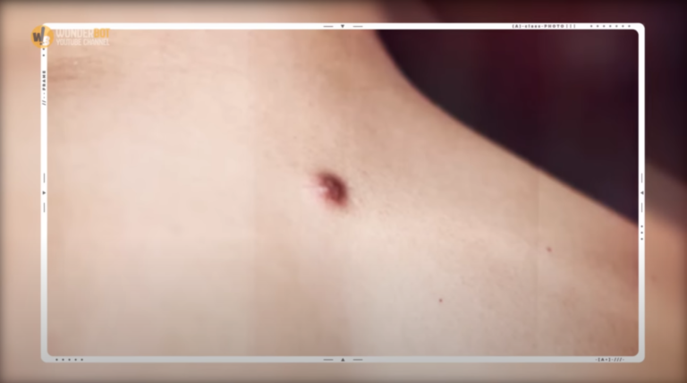 Mom Ignores Pimple on Son’s Back, What Happens Next Is