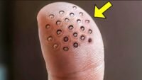 Man Has Weird Round Spots On Finger When The Doctors See It They Call The Cops